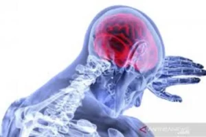 Prediksi risiko stroke, peneliti kembangkan perangkat arteri pada cip