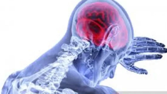Prediksi risiko stroke, peneliti kembangkan perangkat arteri pada cip