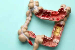 Radang Usus Buntu: Kenali Gejala dan Risiko Komplikasinya